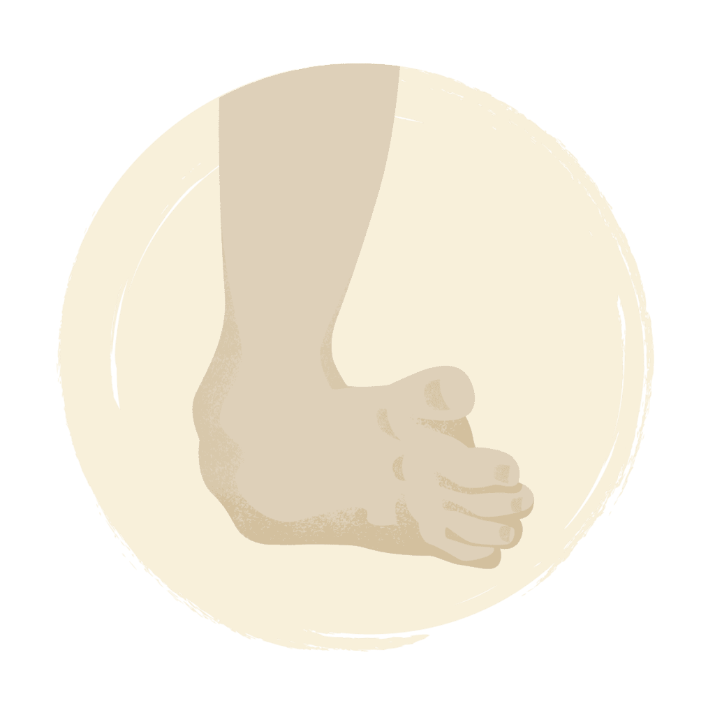 Clubfoot - Tebow CURE Hospital